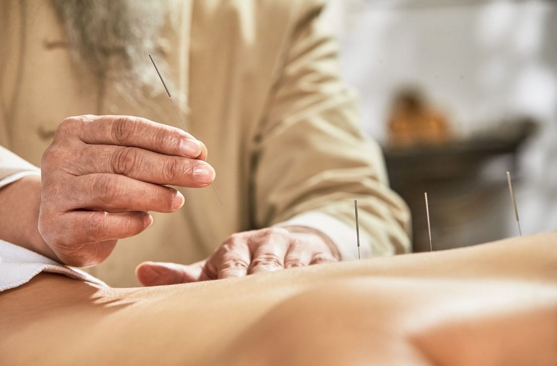 Séance d’acupuncture : aiguilles posées sur le dos d’un patient